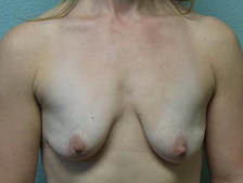 Breast Lift With Augmentation 7