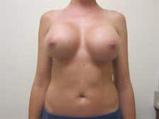 Breast Augmentation Gallery 6 Breast Augmentation Gallery 6
