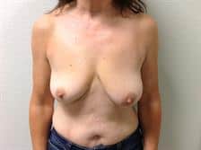 Breast Lift With Augmentation 11