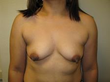 Breast Augmentation Gallery 35