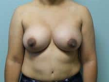 Breast Augmentation Gallery 36