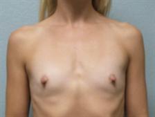 Breast Augmentation Gallery 33