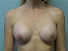 Breast Augmentation Gallery 38