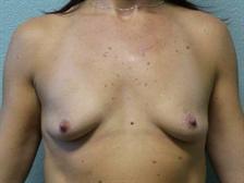 Breast Augmentation Gallery 41