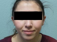Rhinoplasty 2 Rhinoplasty 2