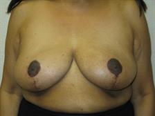 Breast Reduction Gallery 2