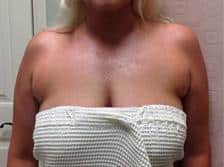 Axillary Breast Tissue Gallery 1
