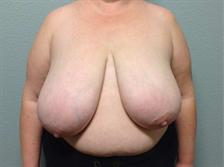 Breast Reduction Gallery 3