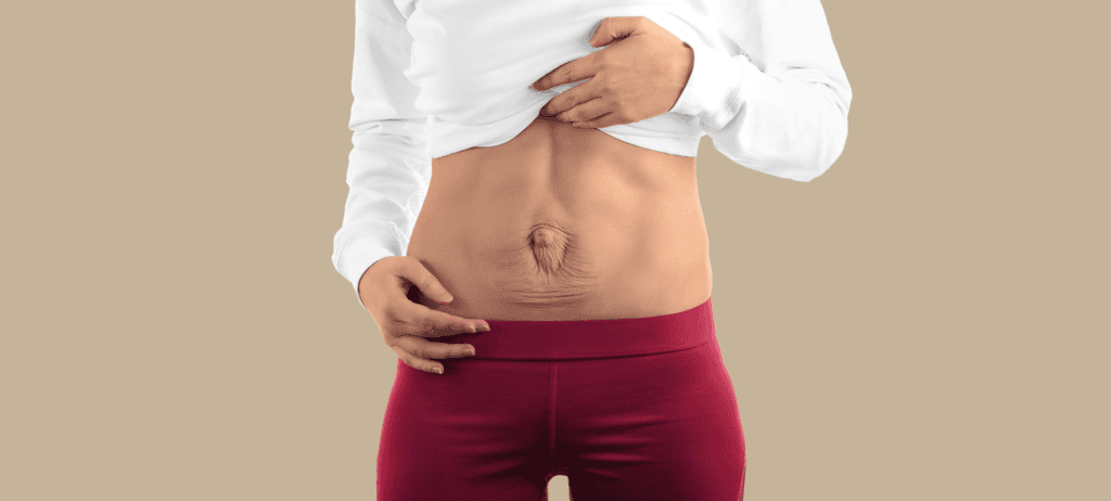 How to correct diastasis after pregnancy? 9 How to correct diastasis after pregnancy? 3