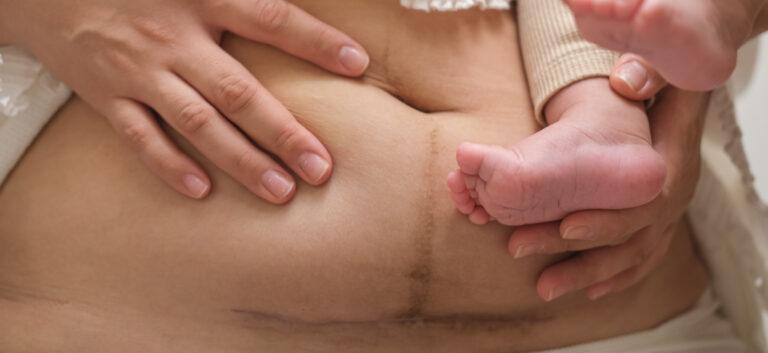 Abdominoplasty after pregnancy